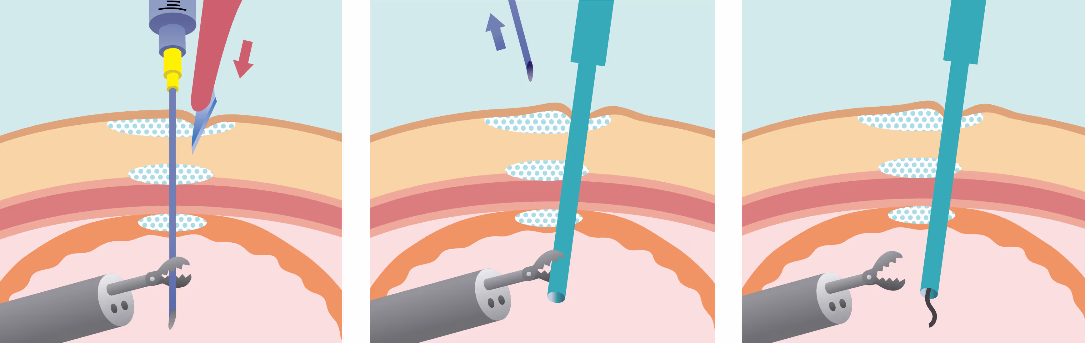 Medical procedure